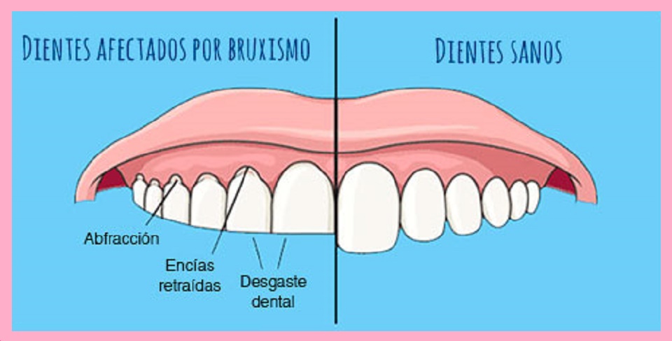 Bruxismo y férulas dentales  Clínica dental Bugella & Rubio
