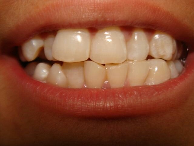 Maloclusion Dental, Que Es La Maloclusion Dental